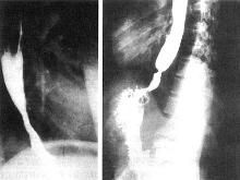 食管造影 食管造影