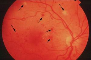糖尿病性視網膜病
