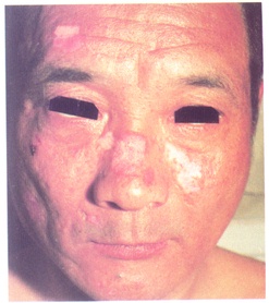 系統性紅斑狼瘡所致脊髓病