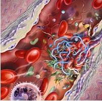 血管炎性周圍神經病