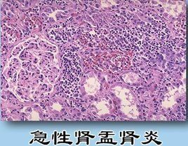 急性腎盂腎炎症狀