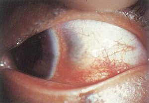 帶狀皰疹病毒性鞏膜炎