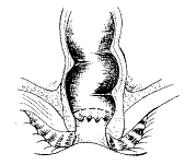腸系膜上動脈栓塞