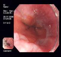 （圖）胃酸患者胃部圖片