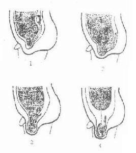 睪丸下降 睪丸下降