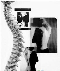 腰椎骨刺 腰椎骨刺