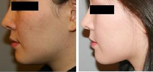 塑美極前後對比圖