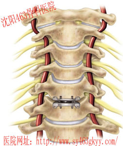 強直性脊髓炎 強直性脊髓炎