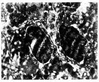 房室結內折返性心動過速 房室結內折返性心動過速