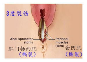 會陰Ⅲ度裂傷