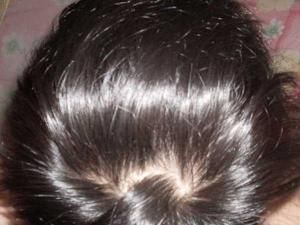 溢脂性脫髮 溢脂性脫髮