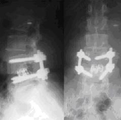 盤源性腰痛 盤源性腰痛