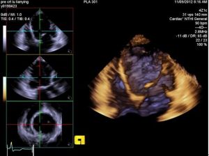 擴張型心肌病的三維超聲心動圖圖像