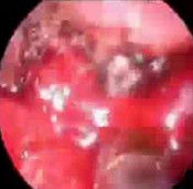 惡性纖維組織細胞瘤 惡性纖維組織細胞瘤