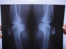 膝蓋骨質增生