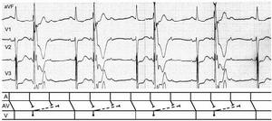 圖5室性早搏引起的逆行性隱匿性傳導