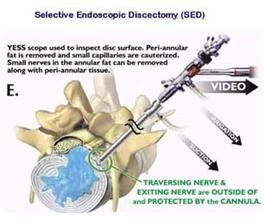 內窺鏡鐳射物理技術 內窺鏡鐳射物理技術
