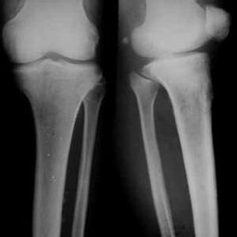 非骨化性纖維瘤 非骨化性纖維瘤