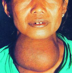 甲狀腺腫大 甲狀腺腫大