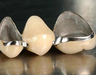 鎳鎘烤瓷牙