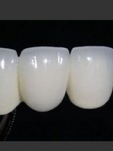 普通烤瓷牙 普通烤瓷牙