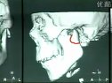 《頜面部骨折手術復位堅固內定術》