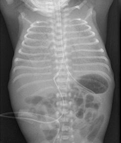 呼吸窘迫綜合症