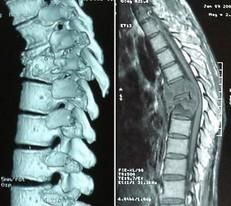 胸椎結核 胸椎結核