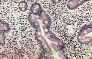 （圖）巨肥厚性胃炎