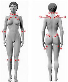 纖維肌痛綜合徵