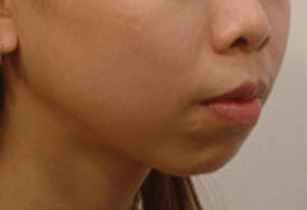 頦部整形美容術