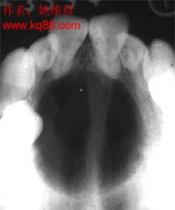 頜骨造釉細胞瘤