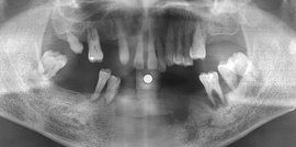 牙槽骨吸收 牙槽骨吸收