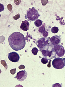 嗜血綜合症 嗜血綜合症