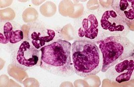 中性粒細胞核左移