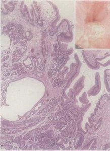 增生性息肉 增生性息肉