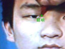 睛明穴