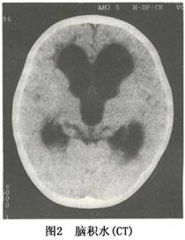 高顱壓性腦積水