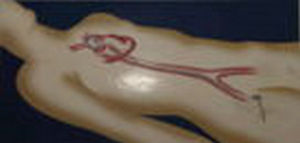 冠狀動脈造影示意圖