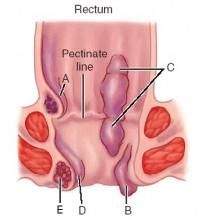 肛腸外科 肛腸外科