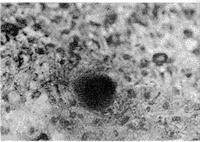 輕鏈病與輕鏈沉積病