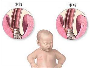 乳汁吸入性肺炎