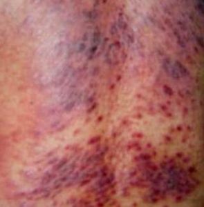 神經性皮炎 神經性皮炎