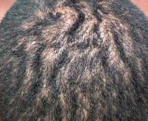 回狀頭皮症 回狀頭皮症