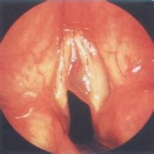 幼年息肉 幼年息肉