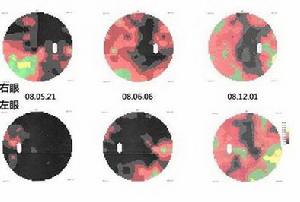 （圖）LEBER遺傳性視神經病