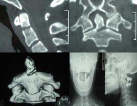 頸椎脫位 頸椎脫位
