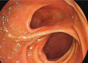 小兒消化道出血 小兒消化道出血