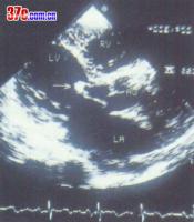 自體瓣膜心內膜炎