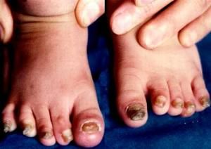 先天性厚甲症 先天性厚甲症